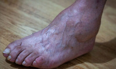 - bigstock closeup feet of old man suffer 338537584 5 1242x621