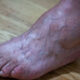 - bigstock closeup feet of old man suffer 338537584 5 1242x621