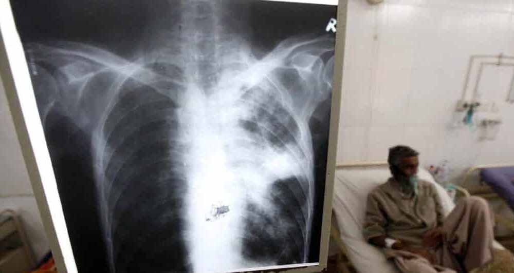 - Tuberculosis mas 1024x532 1