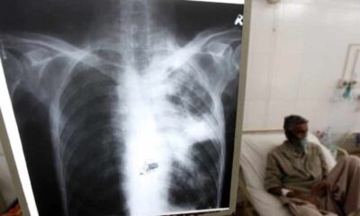 - Tuberculosis mas 1024x532 1