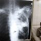 - Tuberculosis mas 1024x532 1
